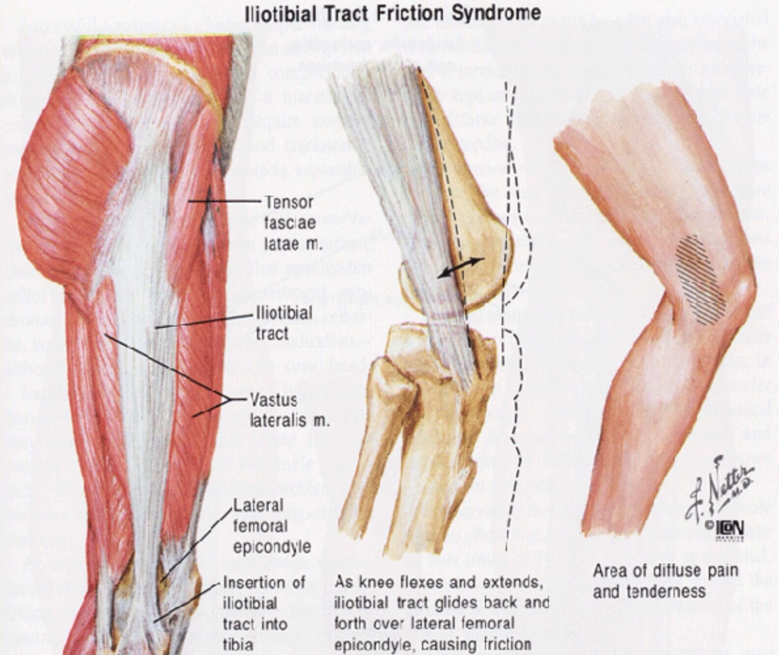 Iliotibial tract syndrome